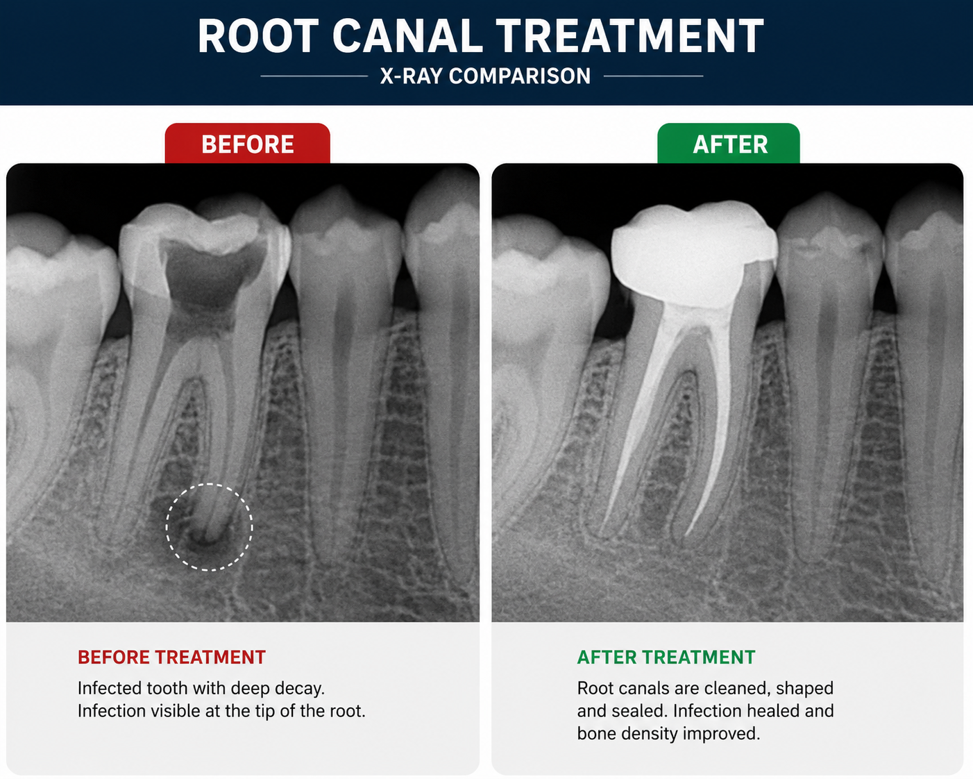 Before and after X-ray comparison of a lower molar treated with root canal treatment